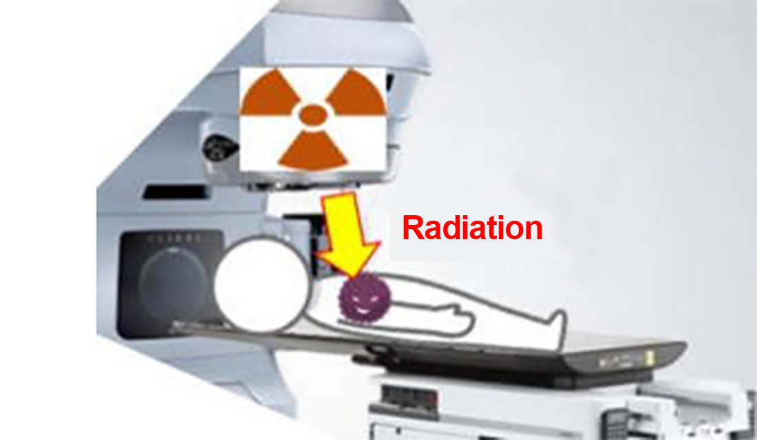 Current Situation of Anti-Cancer Radiation Therapy